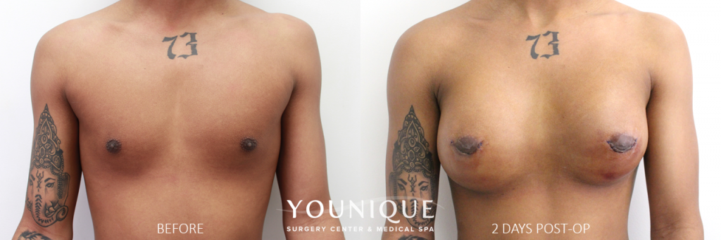 man female breast implants Male to Female Breast Augmentation - 2634